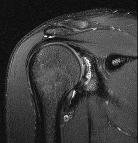Figure 4 for case Osteochondritis dessicans of the glenoid